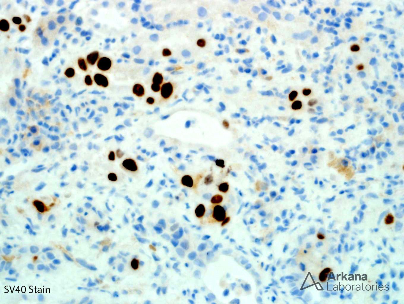 large B-cell lymphoma, A SV40 stain confirms the presence of BK nephritis