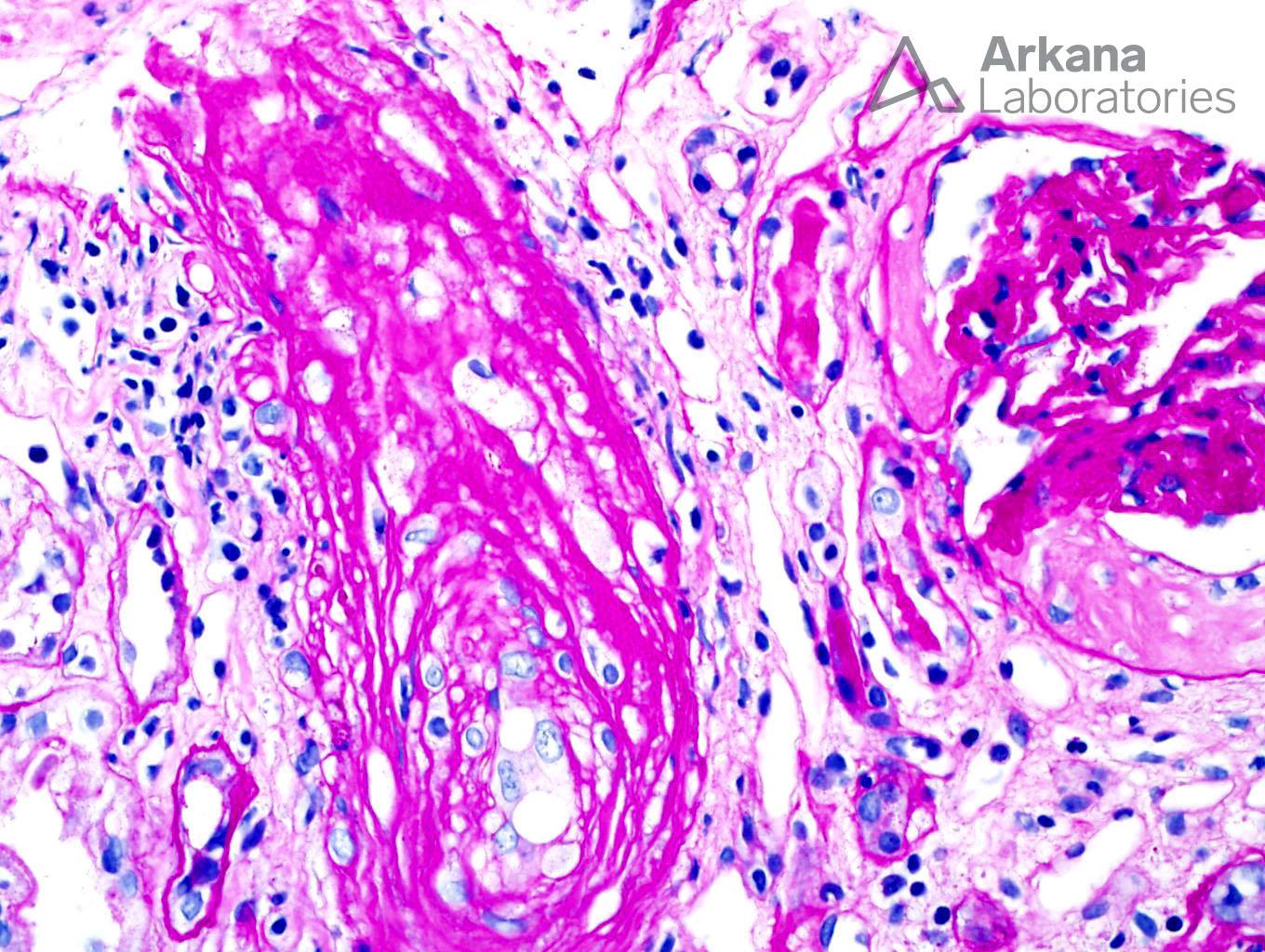 Thrombotic Microangiopathy