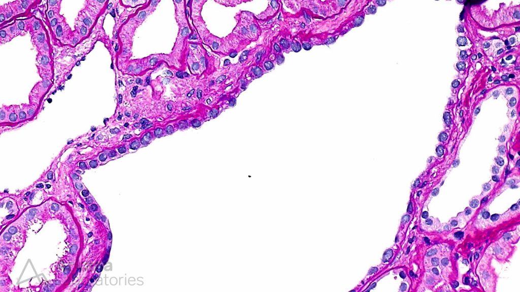 renal biopsy, kidney diagnosis, arkana laboratories