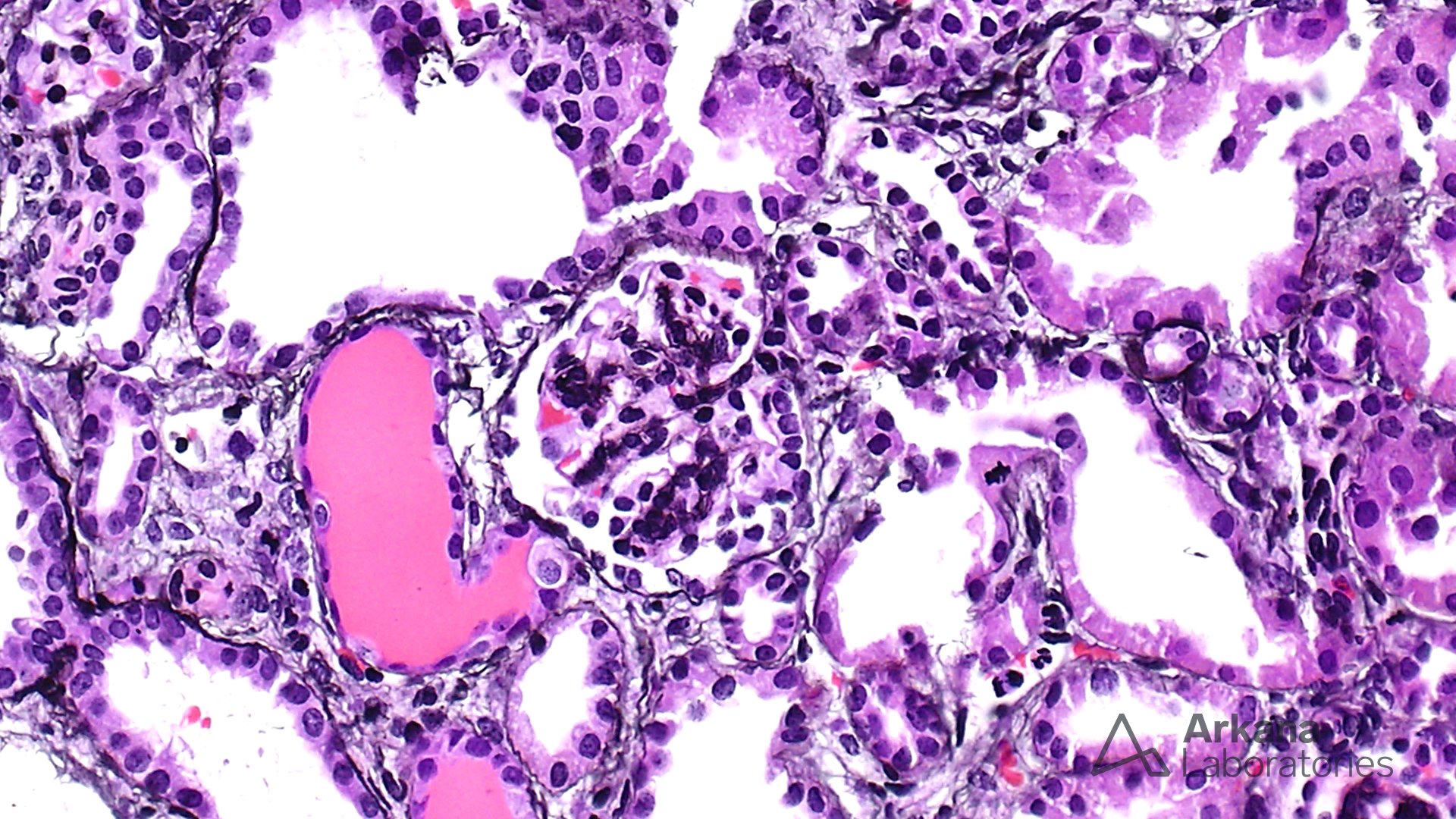 h&e showing tubulitis and glomerulus