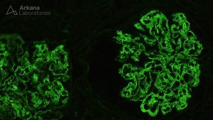 Positive IF stain showing Fibrillary Glomerulopathy