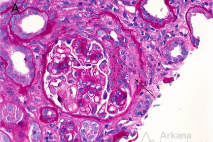 IgA Nephropathy Oxford classification and scoring