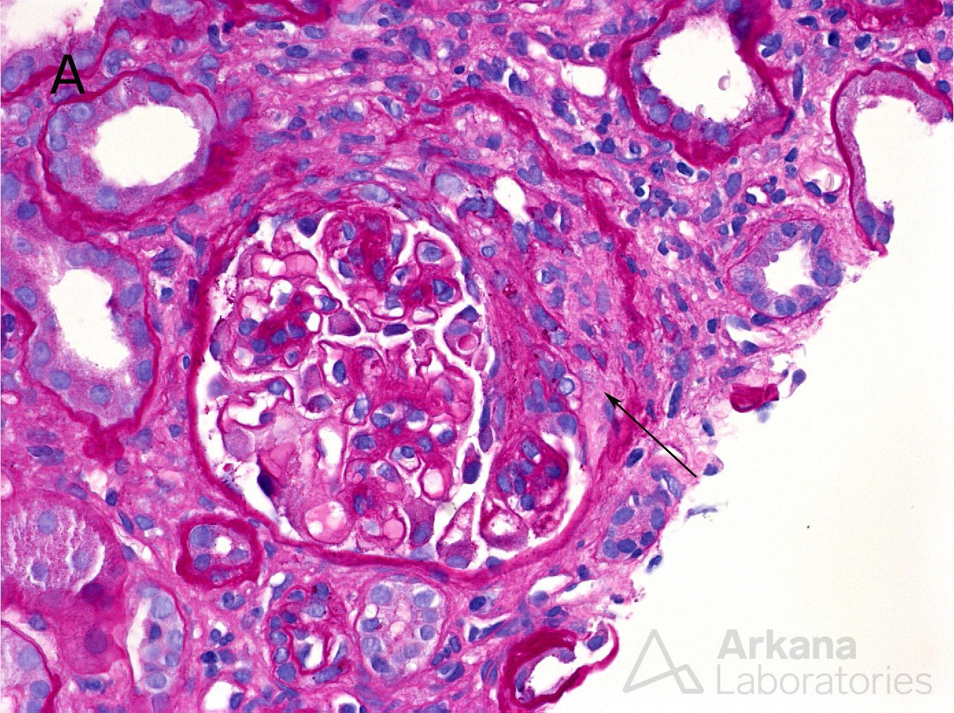 IgA Nephropathy Oxford classification and scoring