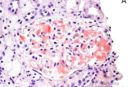 glomerulus with Congo red positive mesangial staining