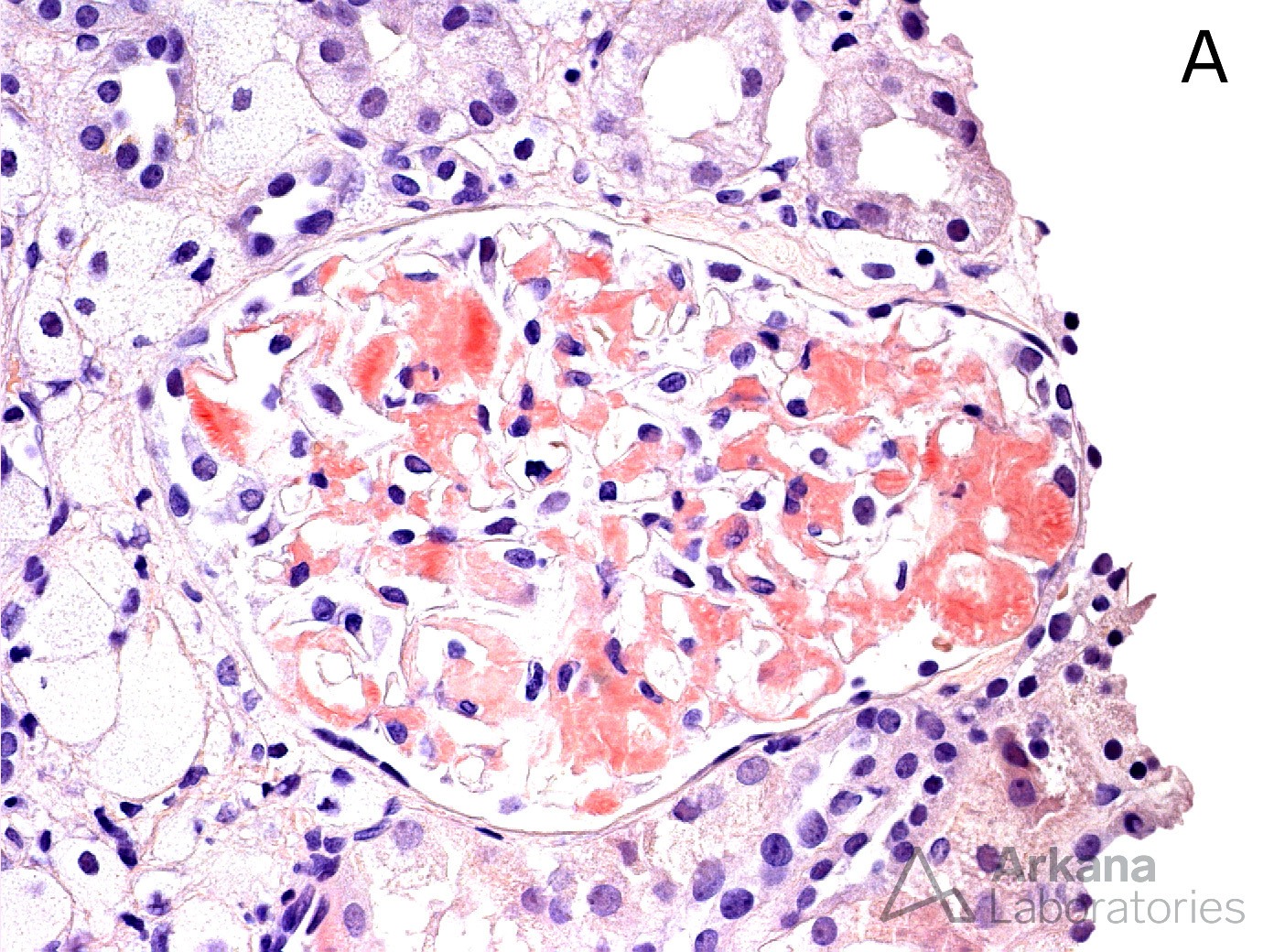 glomerulus with Congo red positive mesangial staining