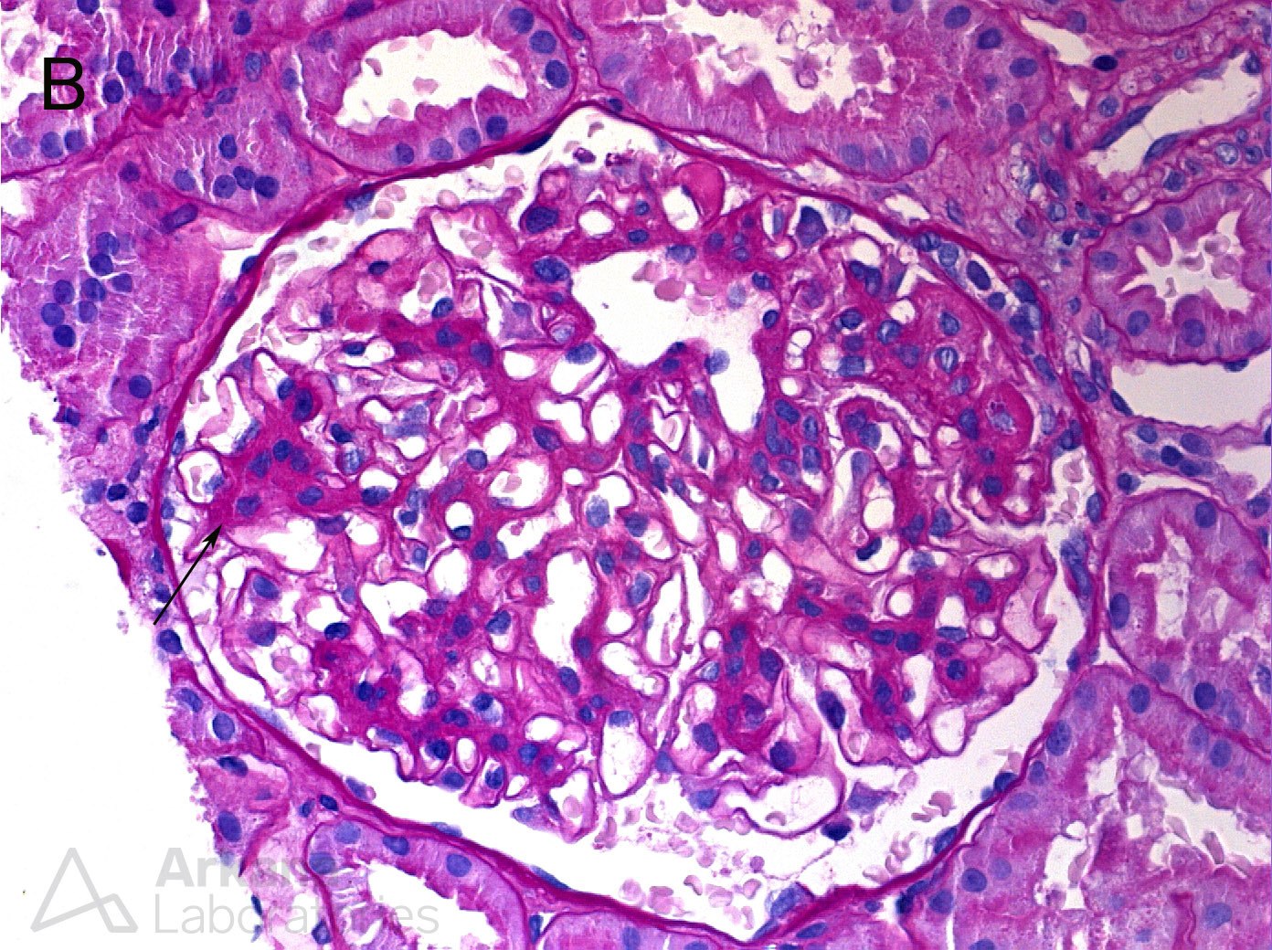 mesangial hypercellularity in glomerulus