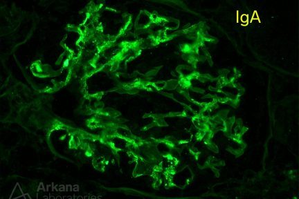 IgA, IgA Differential, IgA nephropathy