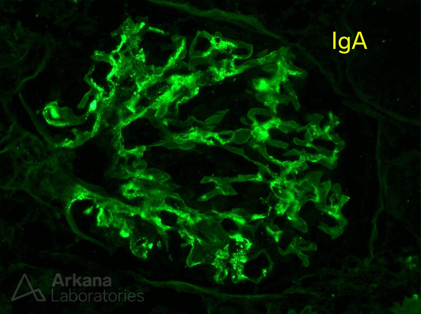 IgA, IgA Differential, IgA nephropathy