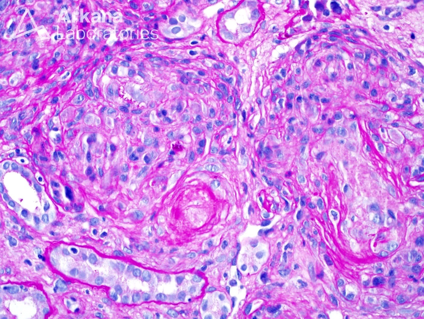 Thrombotic Microangiopathy