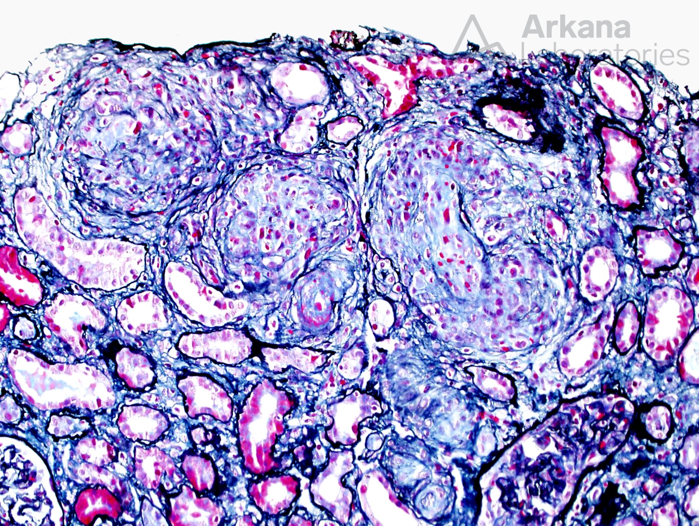 Thrombotic Microangiopathy