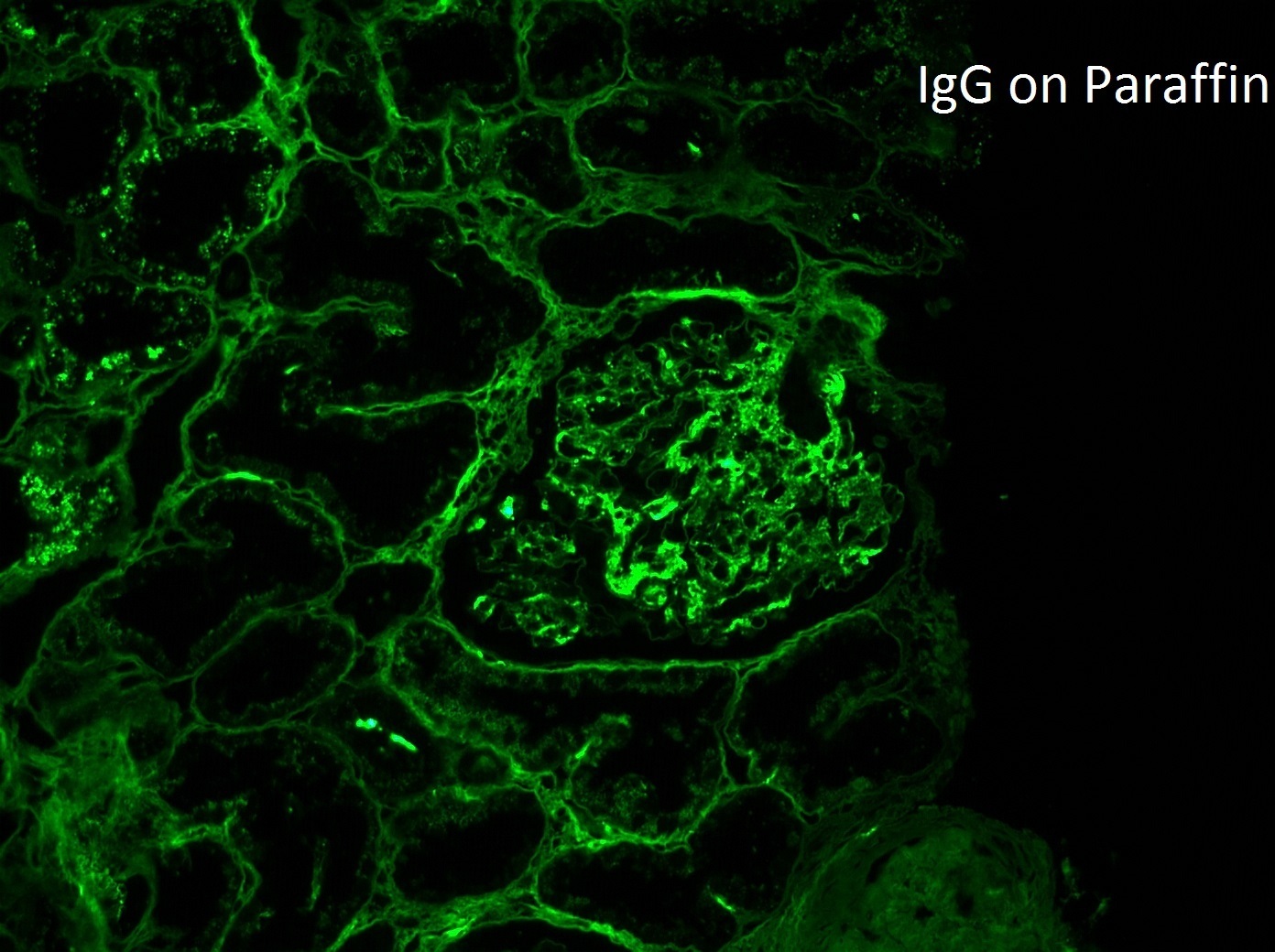 monoclonal IgG kappa deposits refers to a glomerulonephritis which stains for IgG, C3, and kappa by direct immunofluorescence
