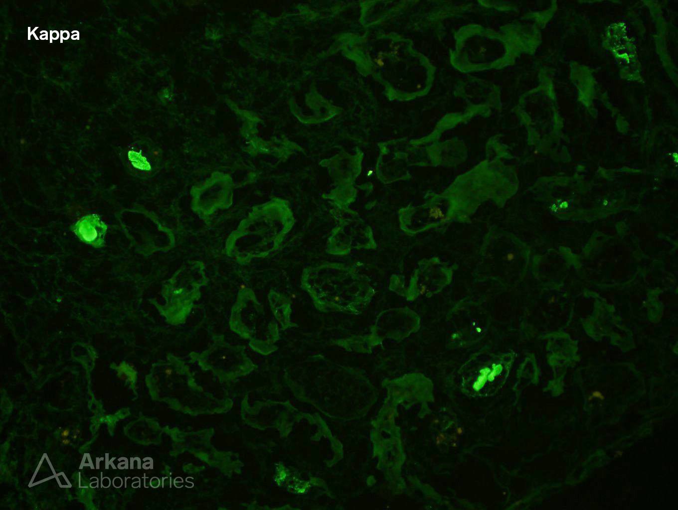 Light Chain Deposition Disease