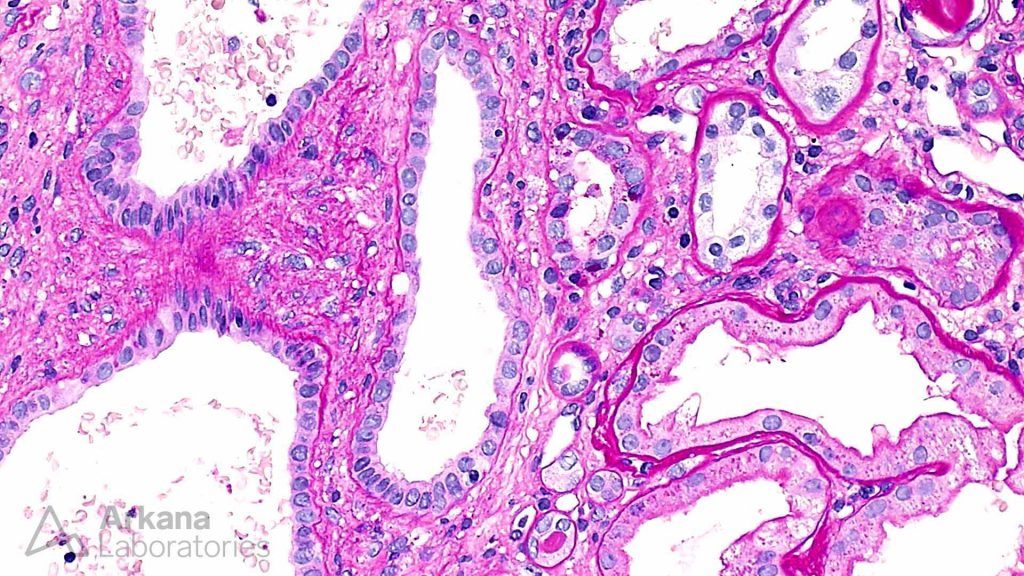 Microcystic tubular dilitation, lithium, acute kidney issues