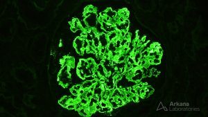 Positive IF stain of Glomerulus showing Fibrillary Glomerulopathy