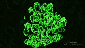 Positive IF stain of Glomerulus showing Fibrillary Glomerulopathy