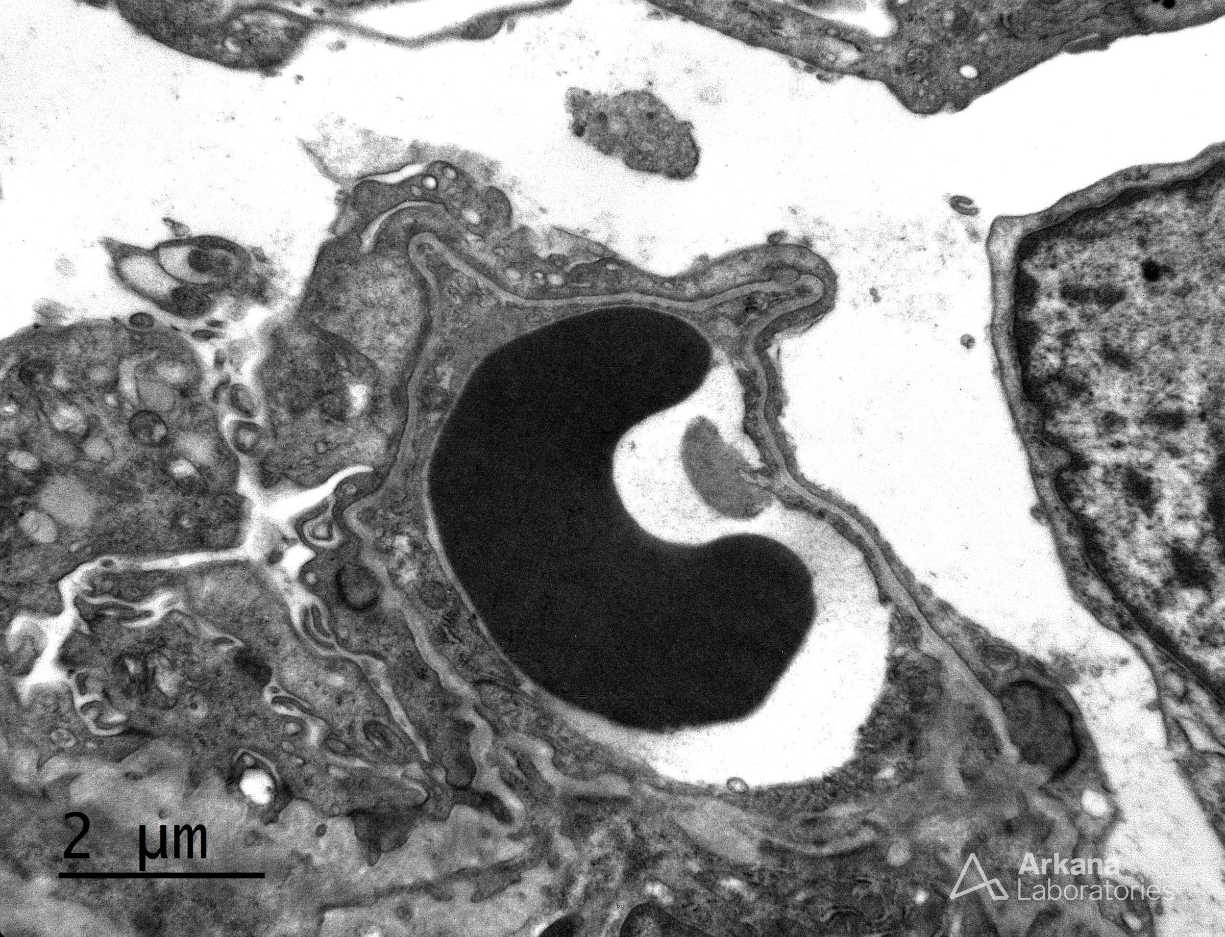 Congenital Nephrotic Syndrome of the Finnish type (CNSF)