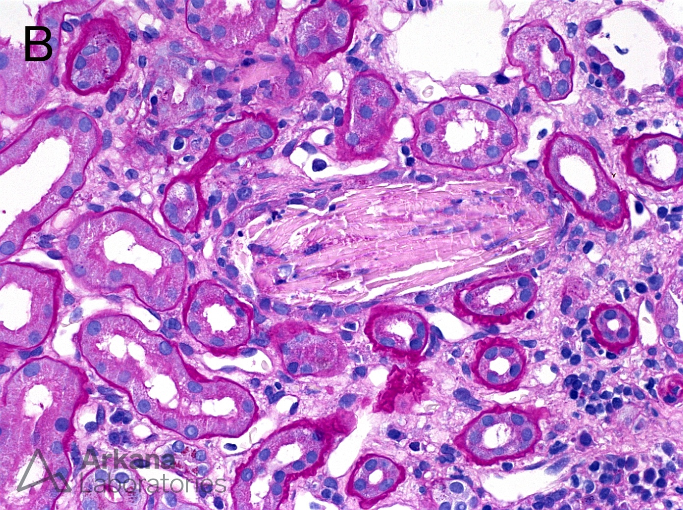 elongated crystalline appearance, tubular casts, renal casts, casts