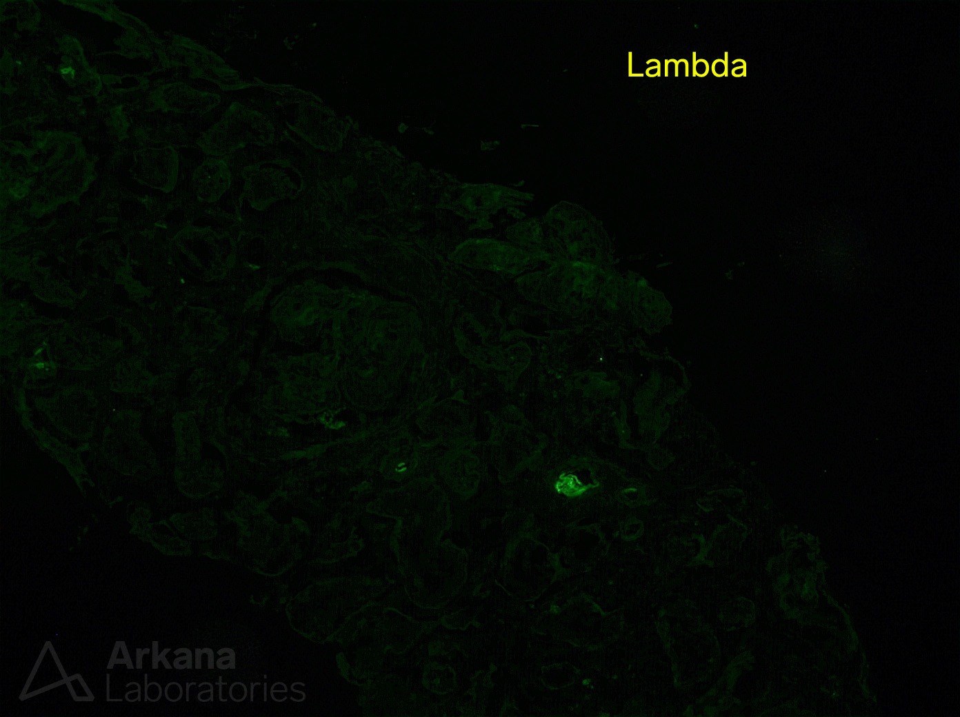 Light Chain Deposition Disease