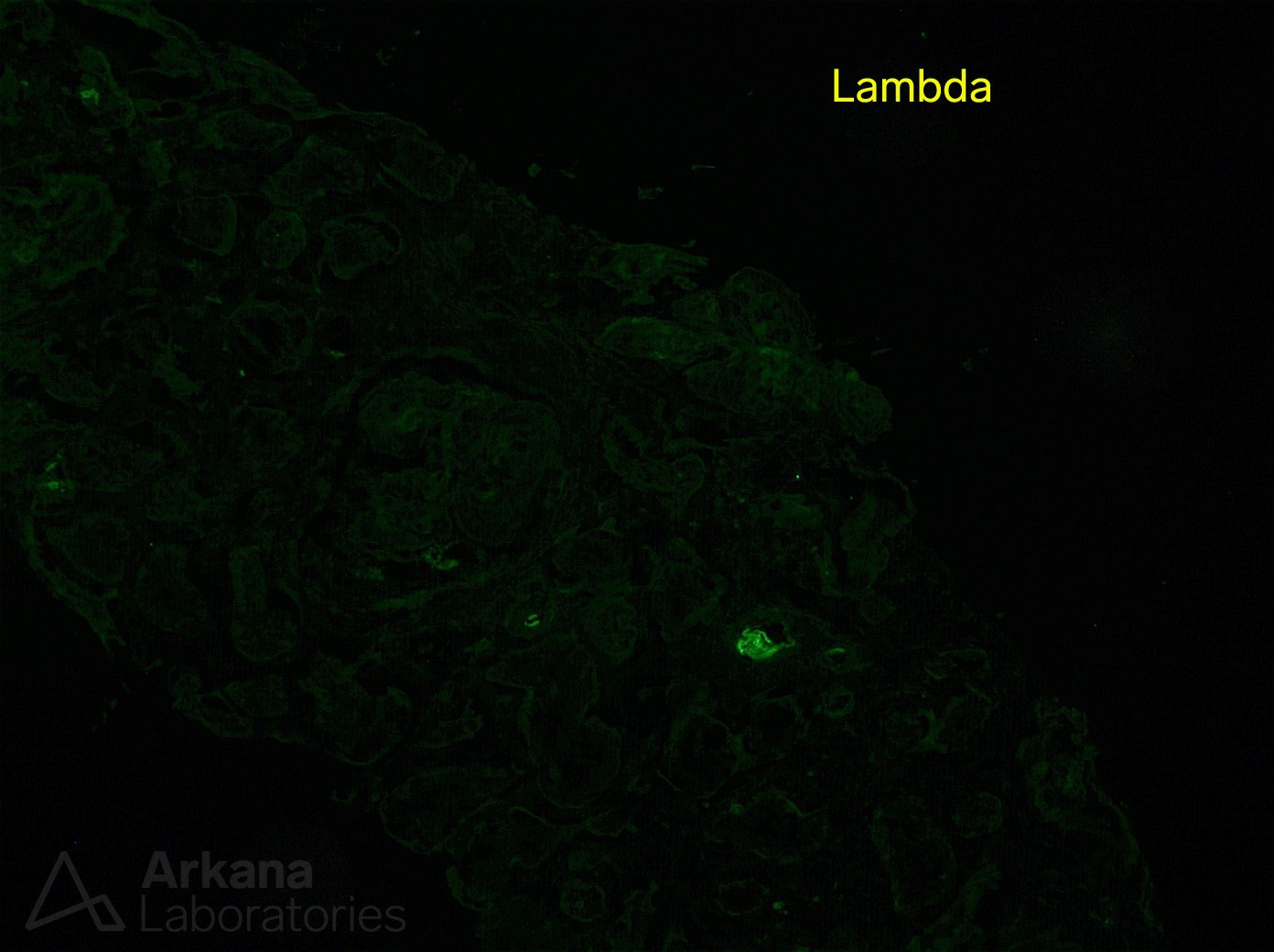 Light Chain Deposition Disease