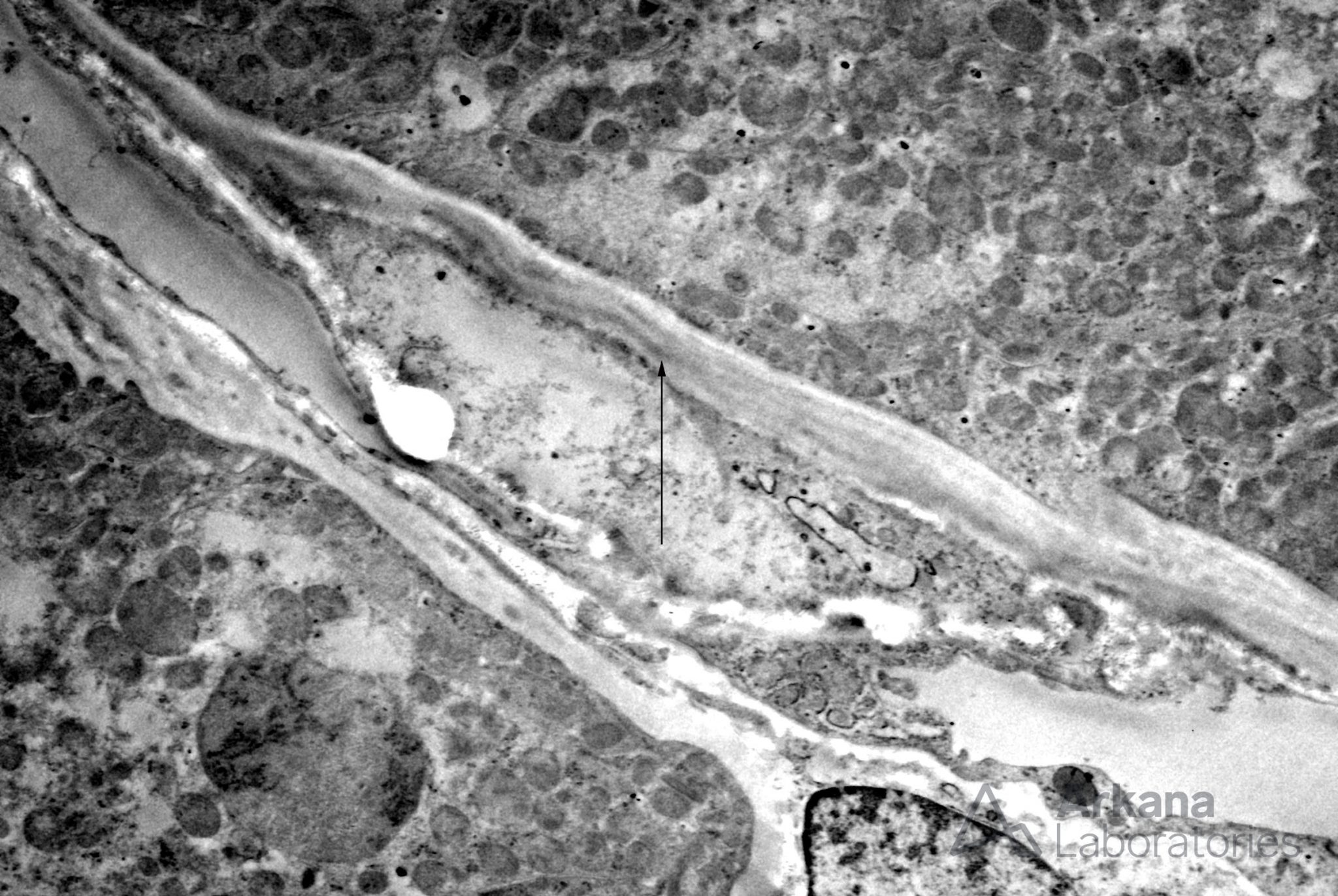 Light Chain Deposition Disease Teaching Points Arkana Laboratories