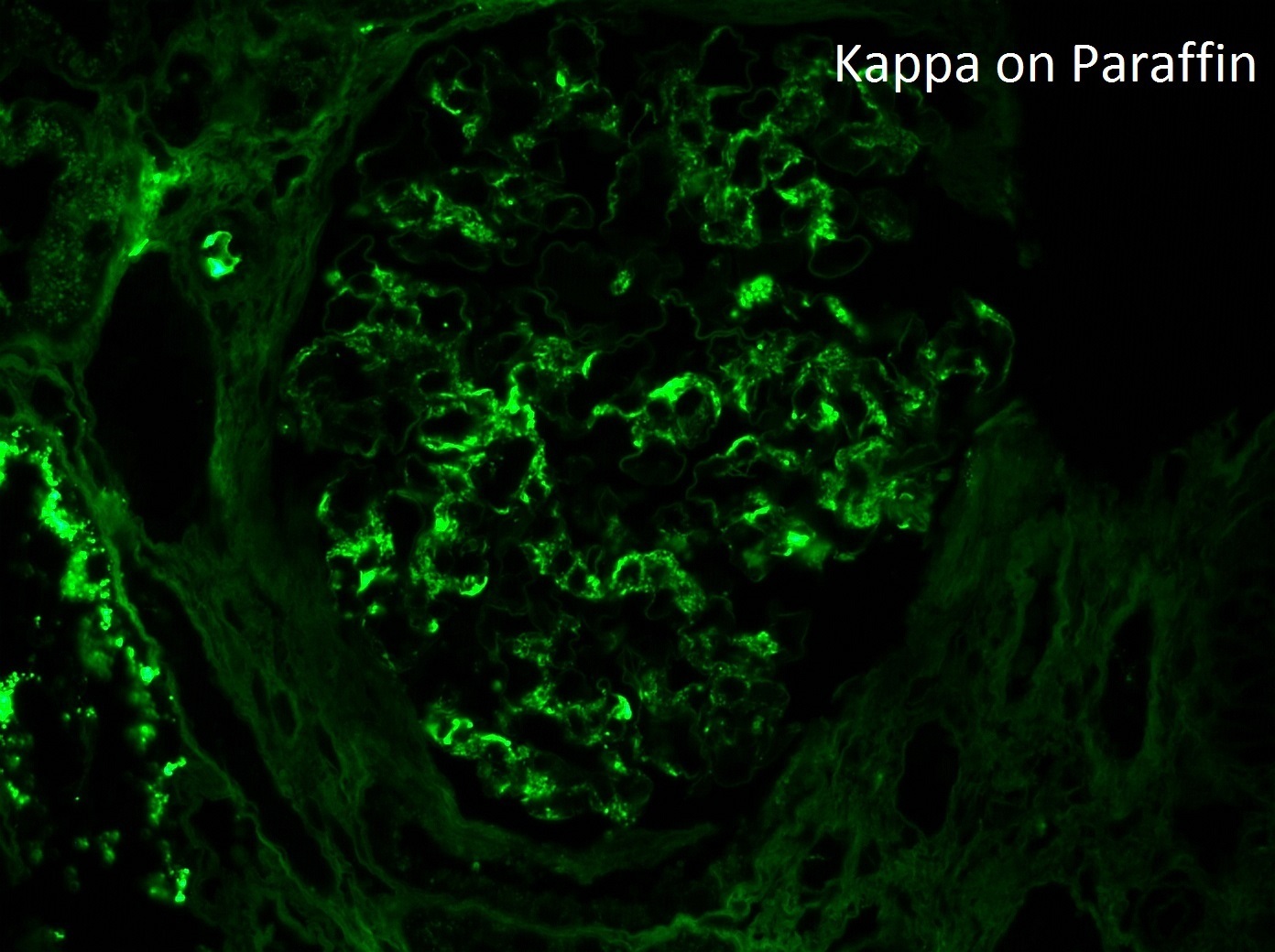 monoclonal IgG kappa deposits refers to a glomerulonephritis which stains for IgG, C3, and kappa by direct immunofluorescence