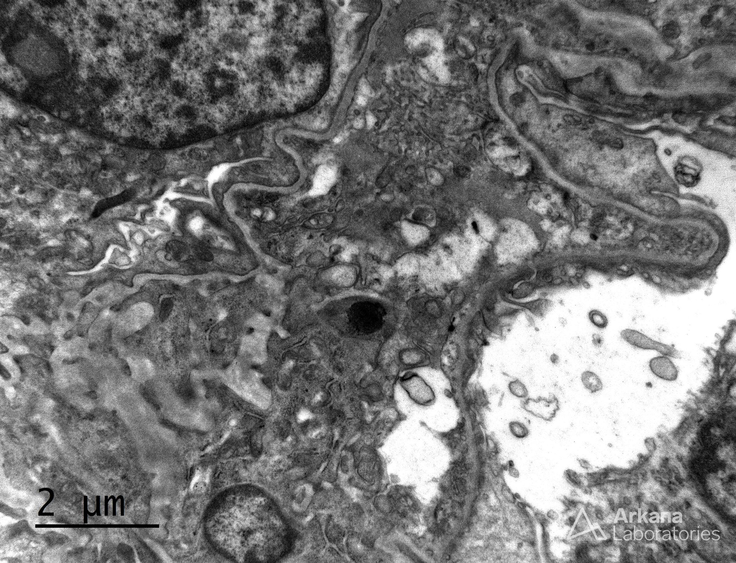 Congenital Nephrotic Syndrome of the Finnish type (CNSF)