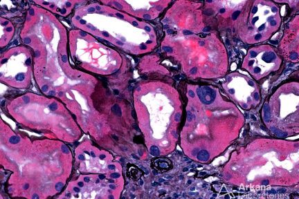 Karyomegalic Nephropathy