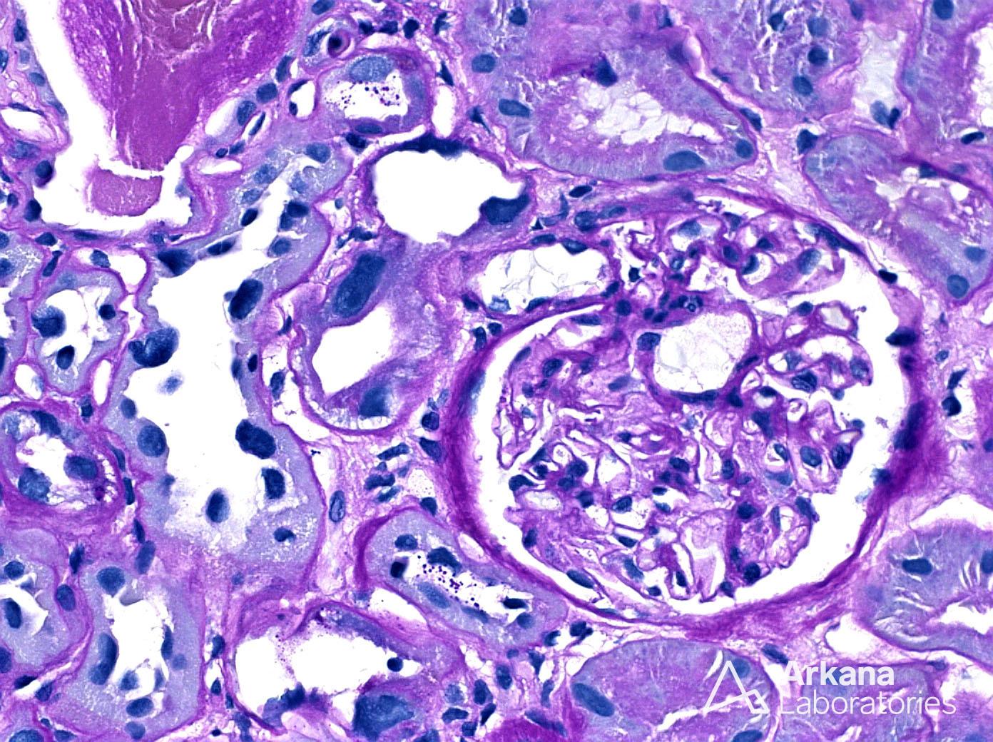 Karyomegalic Nephropathy