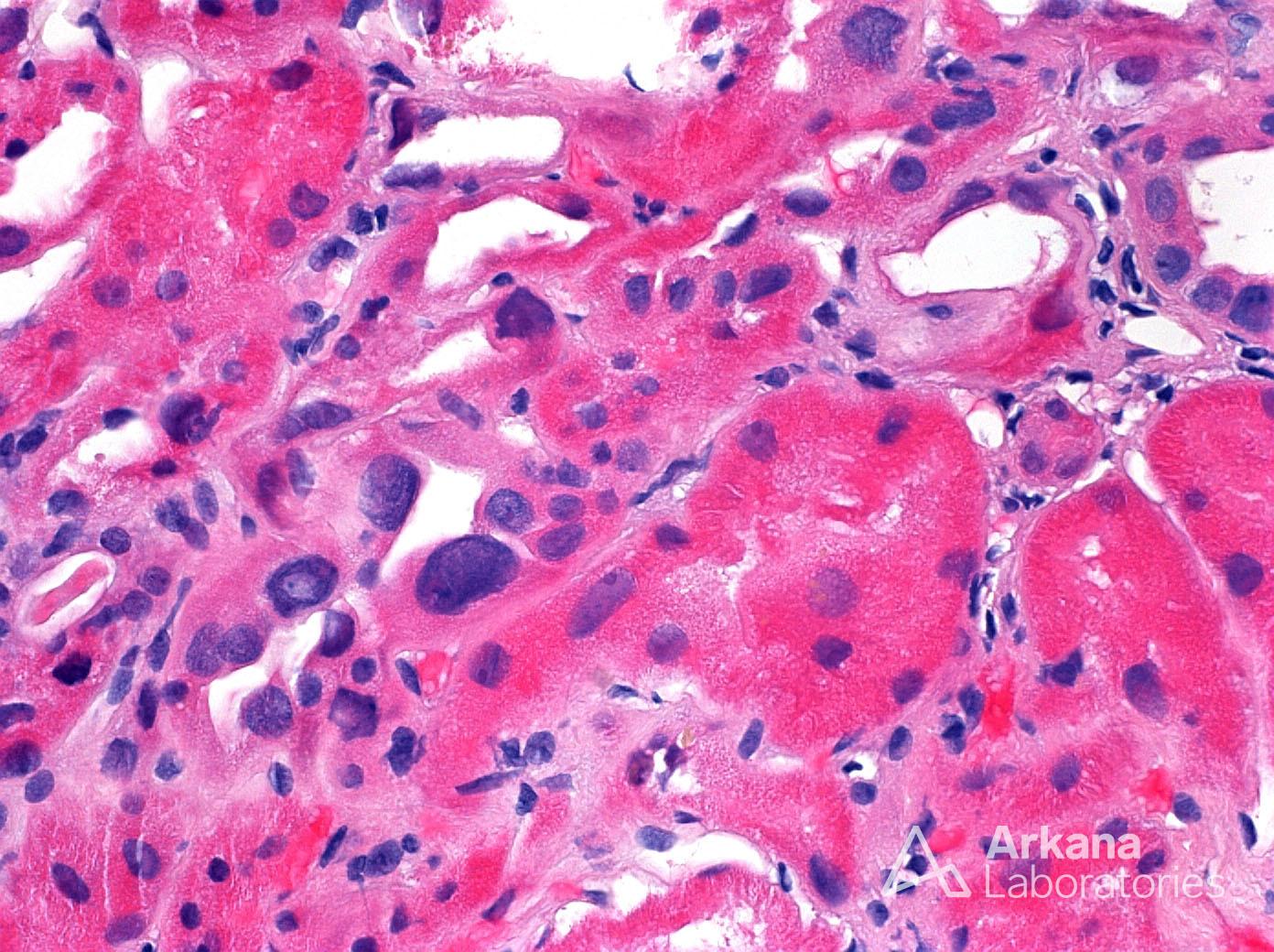 Karyomegalic Nephropathy