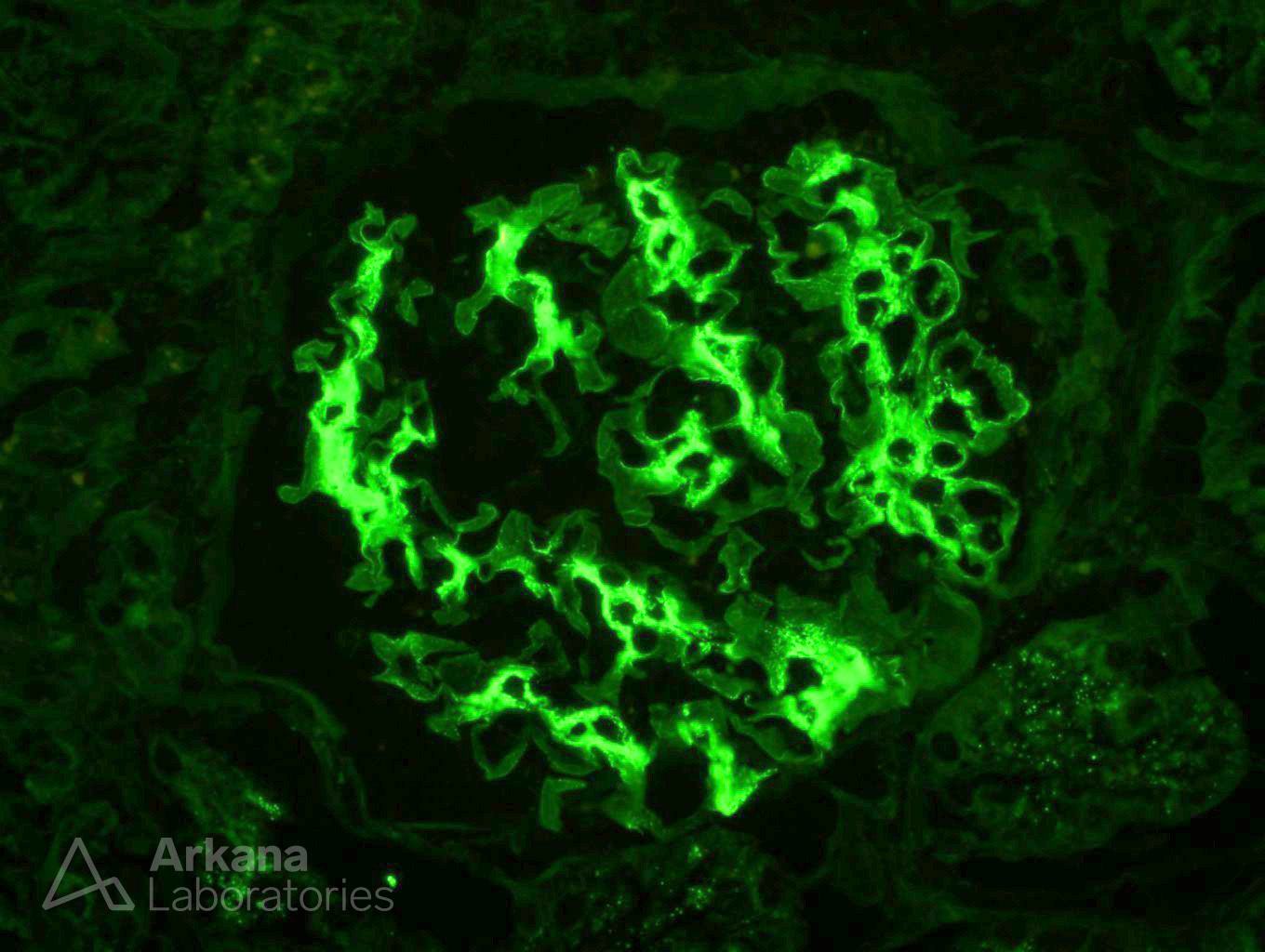 IgA Nephropathy