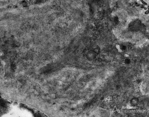 EM image showing positive Fibrillary Glomerulopathy