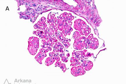 extensive mesangial and subendothelial deposition of PAS-positive