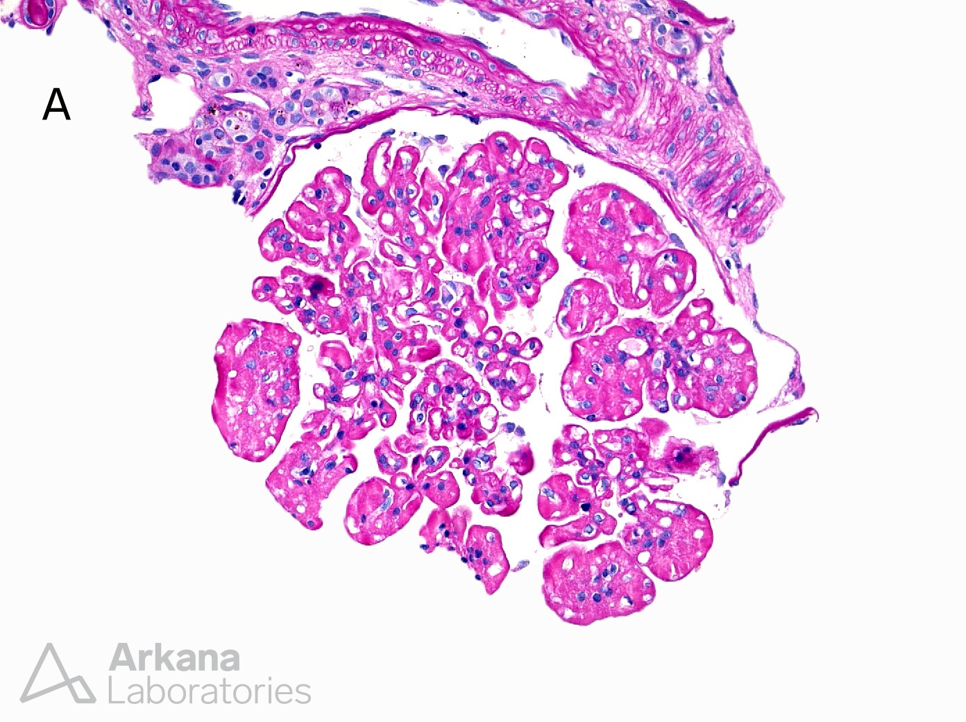 extensive mesangial and subendothelial deposition of PAS-positive