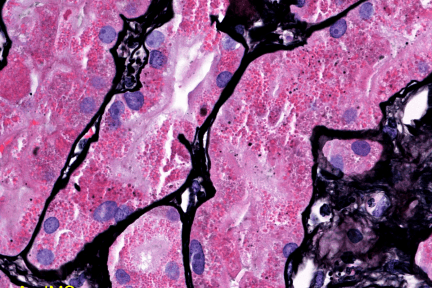 Lysozyme Nephropathy