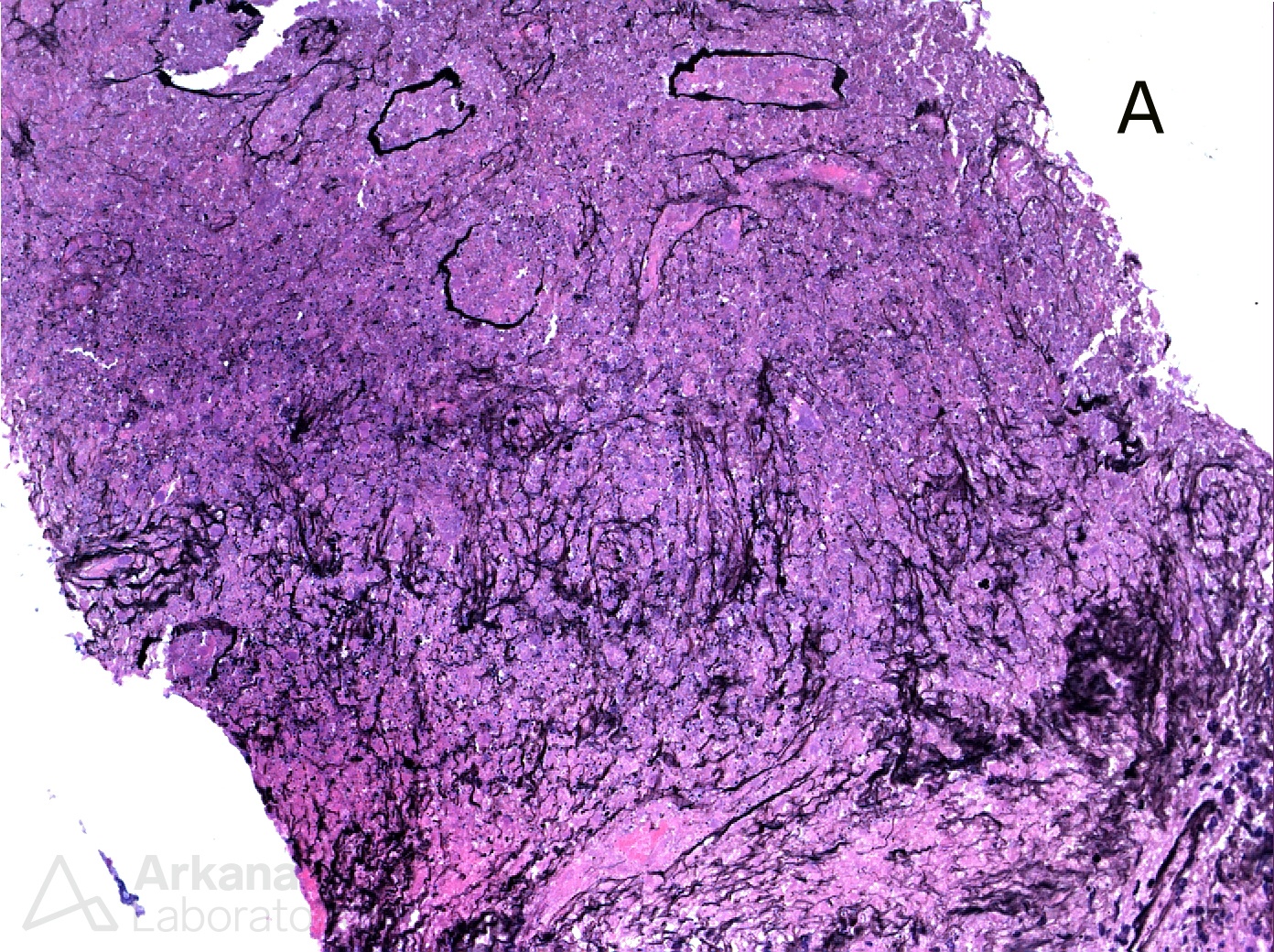 Tuberculosis, caseating necrosis in the renal parenchyma