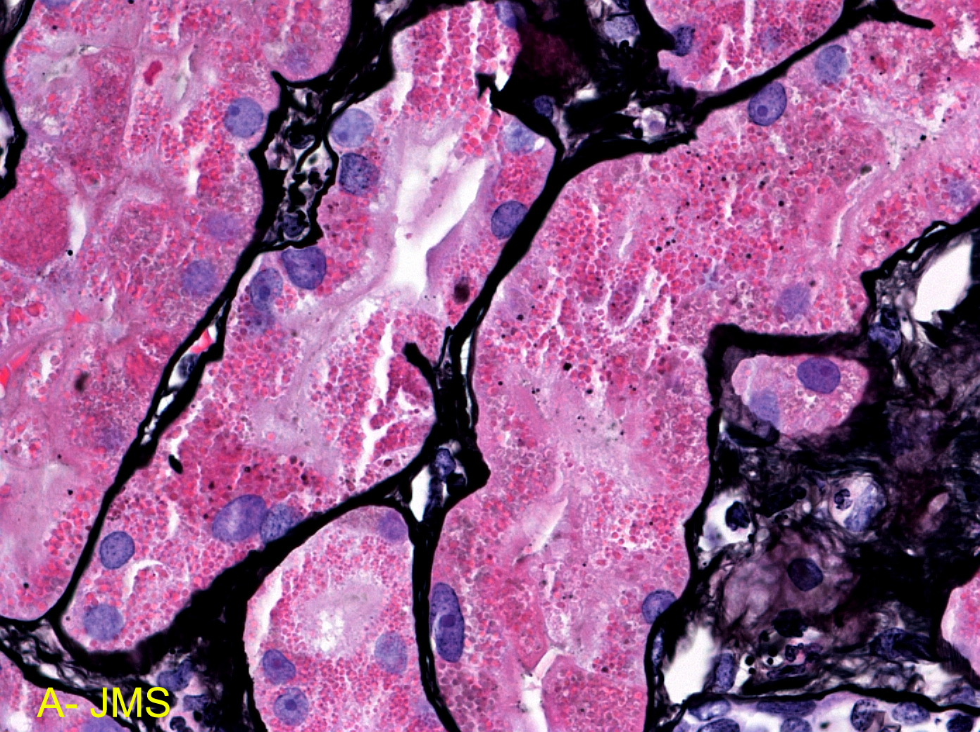 Lysozyme Nephropathy