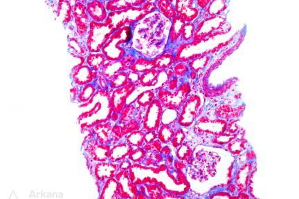 kappa light chain, diagnose this, arkana laboratories, renal pathology