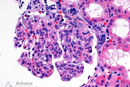 Infection-associated glomerulonephritis