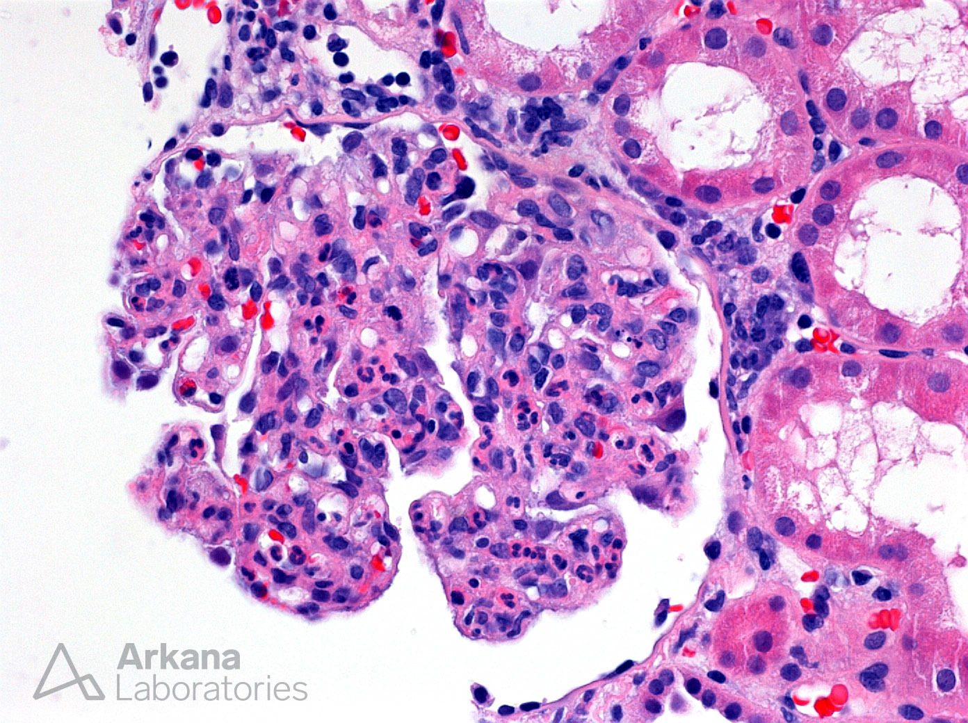 Infection-associated glomerulonephritis