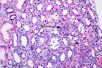 Acute Pyelonephritis, arkana laboratories, renal biopsy, renal disease