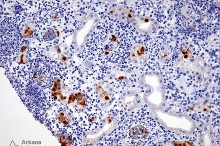 positive adenovirus IHC stain