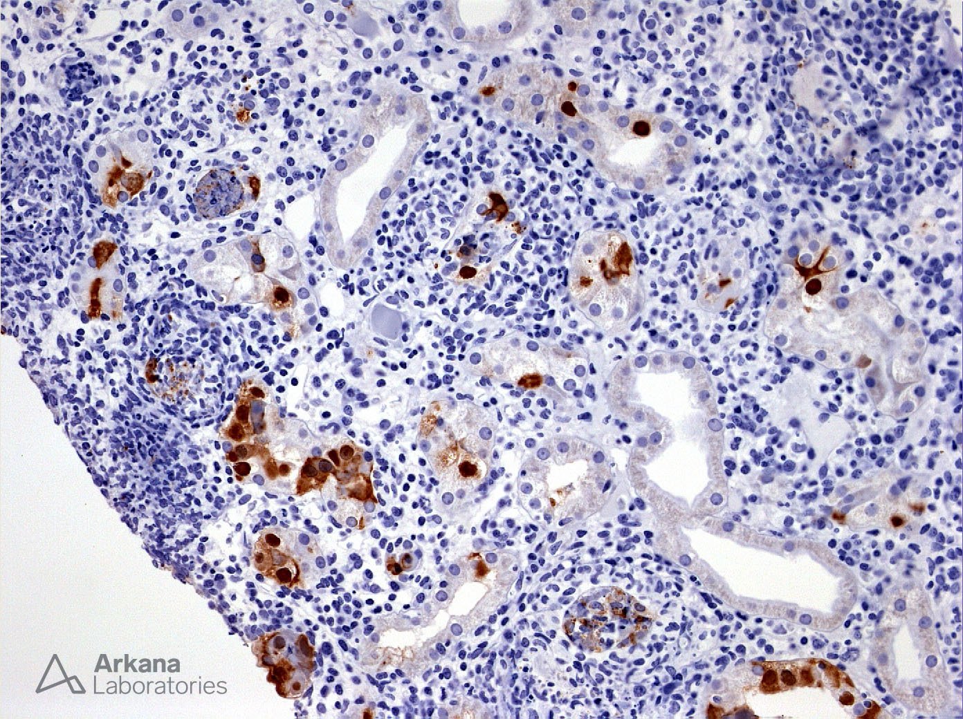 positive adenovirus IHC stain