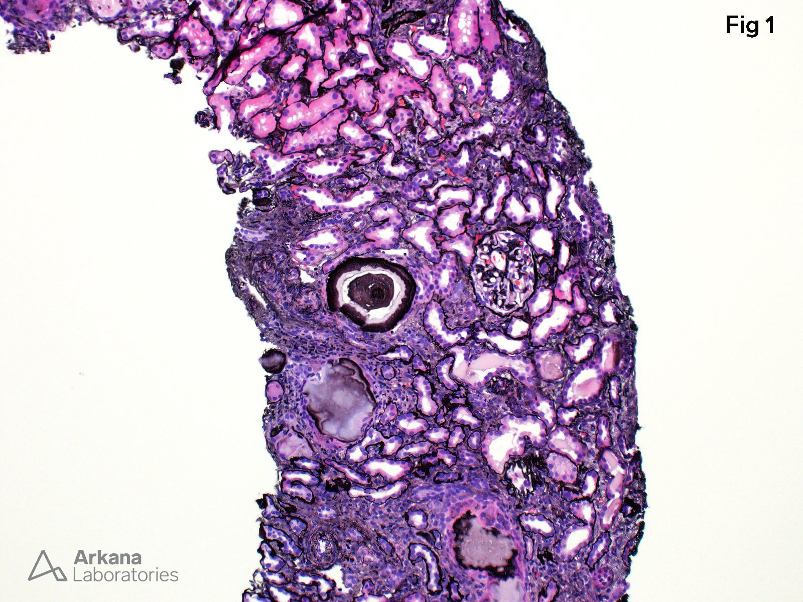 Amyloid Casts