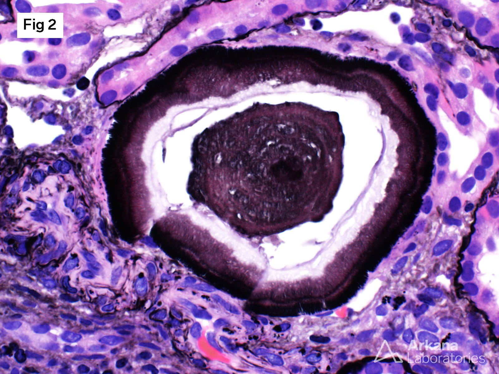large lamellated silver-positive casts with prominent peripheral spicules