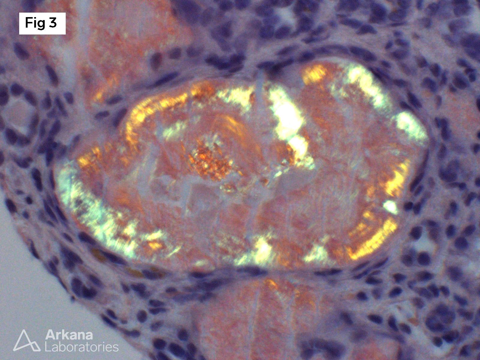 polarized light of positive amyloid casts