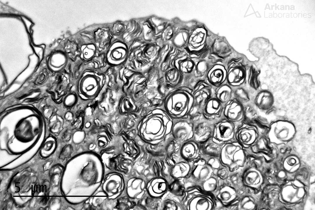 extensive accumulation of intra-podocyte myeloid bodies (a.k.a. zebra bodies, myelinosomes)