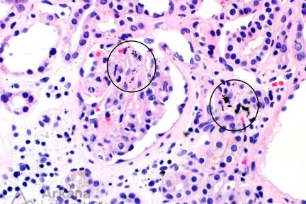 argyria, silver deposits, renal diagnosis, teaching points