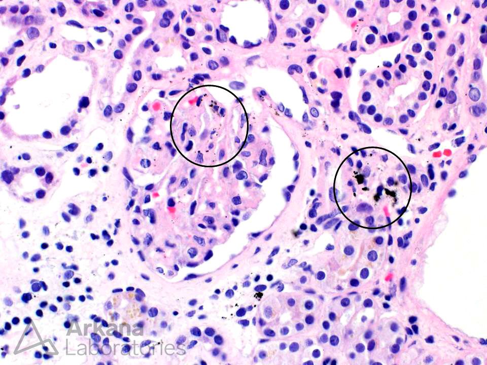 argyria, silver deposits, renal diagnosis, teaching points