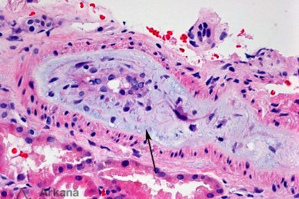 Opana Associated TTP-Like Illness