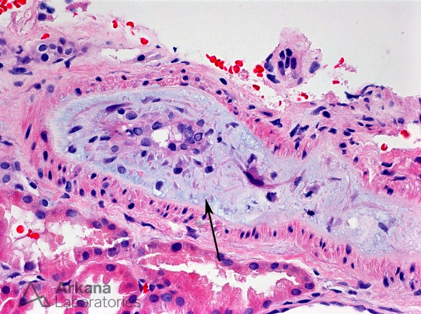 Opana Associated TTP-Like Illness